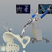 Computer-assisted Hip Replacement