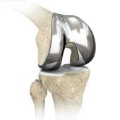 Custom-fitted Total Knee Arthroplasty
