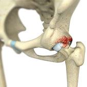 Femoroacetabular Impingement