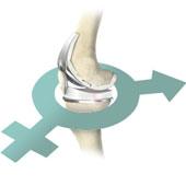 Gender Specific Knee Replacement