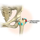 Hip Bursitis