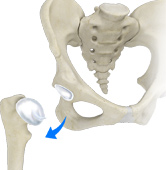 Hip Dislocation