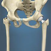 Hip Hemiarthroplasty