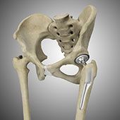 Hip Replacement