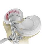 Meniscal Surgery