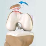 Patellofemoral Instability