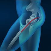 Posterior Hip Replacement