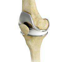 Knee Replacement