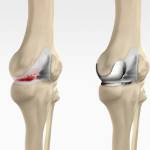 Unicompartmental/Partial Knee Replacement